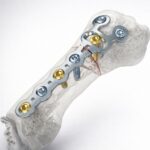 Locking Plate System for Bone Fixation